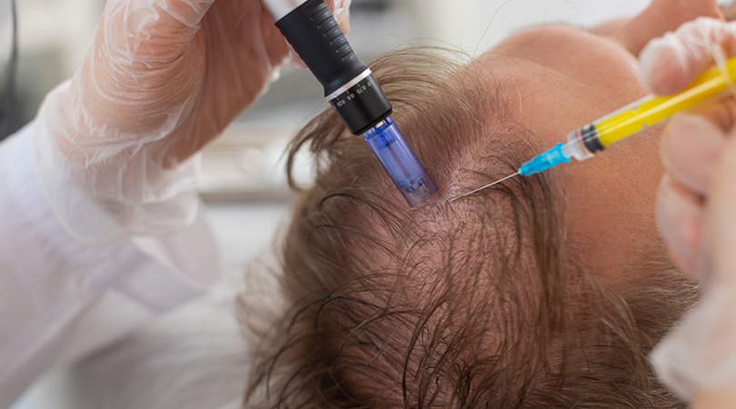 Hair Exosome Therapy