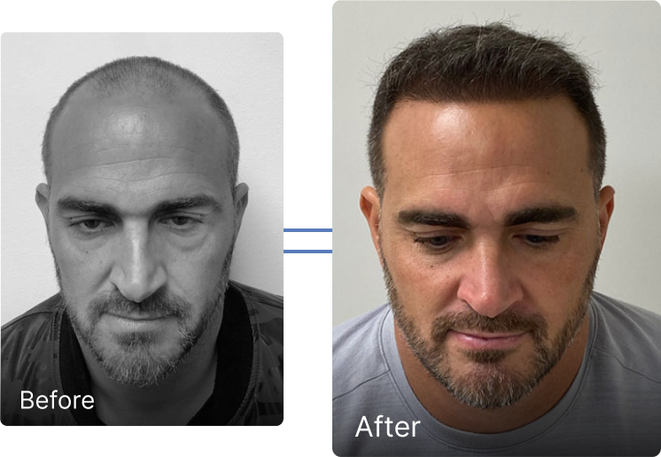Before and after hair restoration