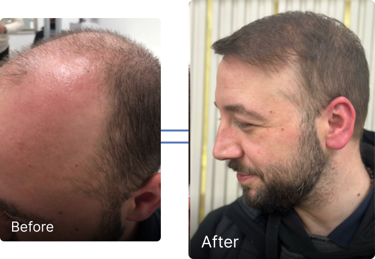 Before and after hair restoration