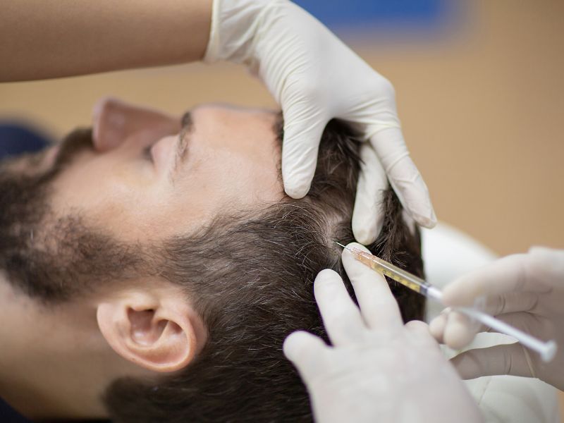 PRF Hair Treatment